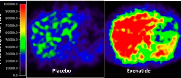Effekt af Exenatid på hepatic glukose optag